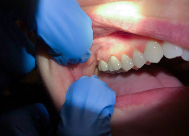 Best Emergency Root Canal Treatment in St Clair, MI